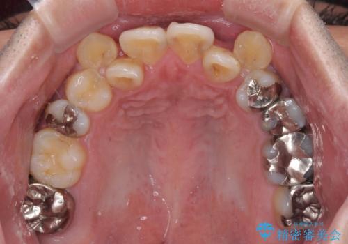 デコボコを治したい 八重歯の抜歯矯正の治療前