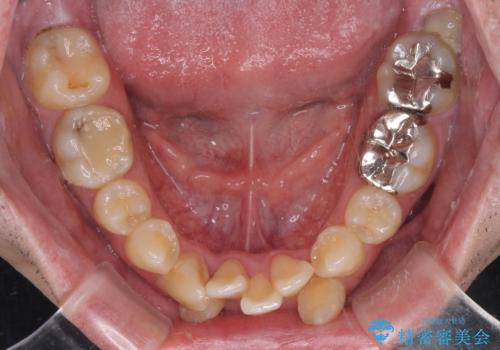 デコボコを治したい　八重歯の抜歯矯正の治療前