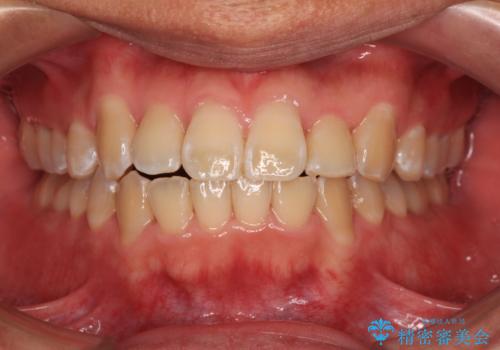 前歯のデコボコを費用を抑えたメタルブラケットできれいにの治療後
