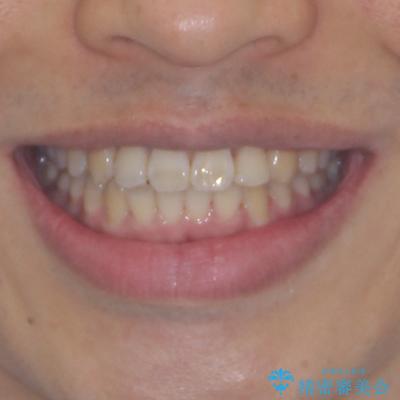 前歯のデコボコを費用を抑えたメタルブラケットできれいにの治療後(顔貌)