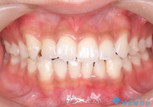 前歯のがたつき 1年かからず治療 マウスピース矯正の治療中