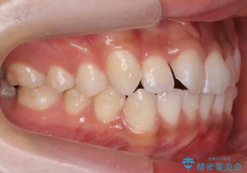 前歯のがたつき　1年かからず治療　マウスピース矯正の治療中