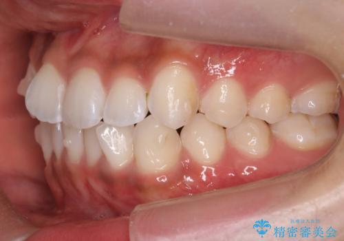 前歯のがたつき 1年かからず治療 マウスピース矯正の治療中