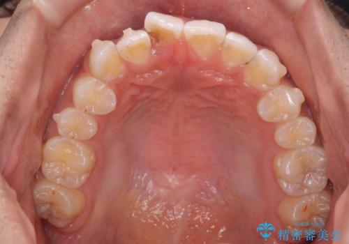 前歯のがたつき 1年かからず治療 マウスピース矯正の治療中