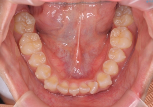前歯のがたつき　1年かからず治療　マウスピース矯正の治療中