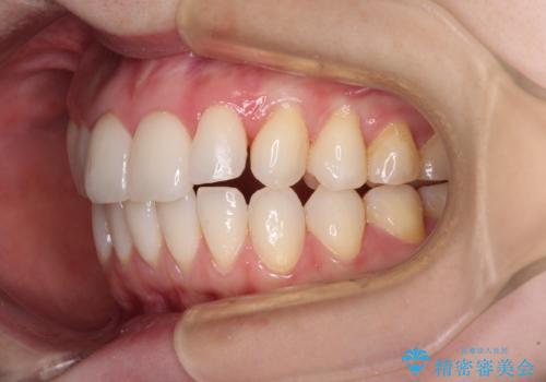 前歯のデコボコをインビザラインで改善の治療中