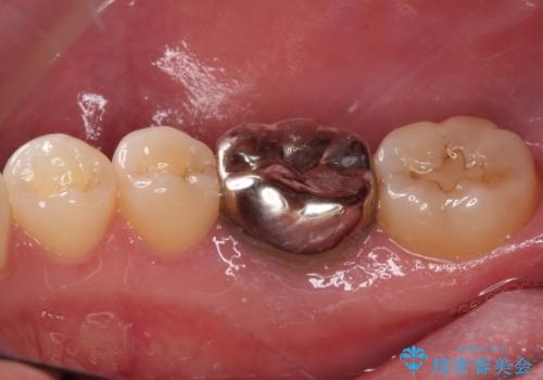 奥歯のむし歯を治したい セラミッククラウンによる補綴治療の治療前