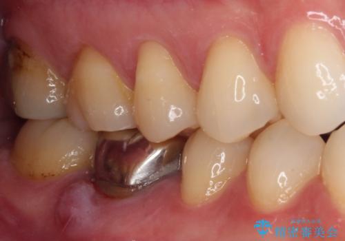 奥歯のむし歯を治したい セラミッククラウンによる補綴治療の治療前