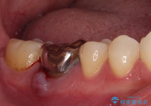 奥歯のむし歯を治したい　セラミッククラウンによる補綴治療の治療前