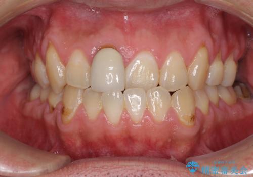 前歯のデコボコとクロスバイトをインビザライン矯正で改善の症例 治療前