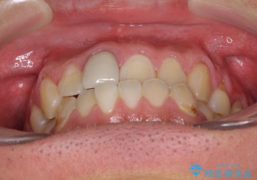 前歯のデコボコとクロスバイトをインビザライン矯正で改善の治療前