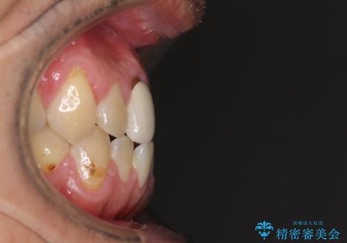 前歯のデコボコとクロスバイトをインビザライン矯正で改善の治療前