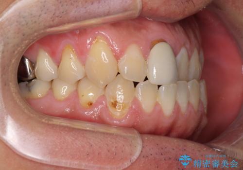 前歯のデコボコとクロスバイトをインビザライン矯正で改善の治療前