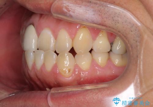 前歯のデコボコとクロスバイトをインビザライン矯正で改善の治療前
