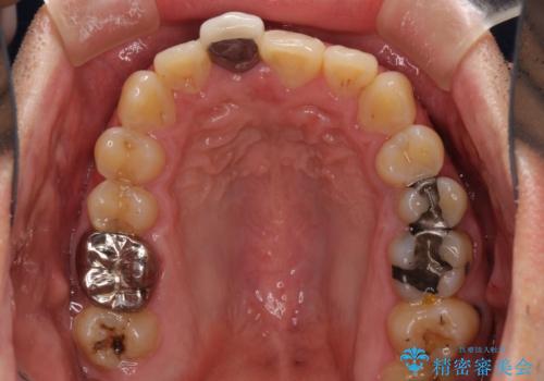 前歯のデコボコとクロスバイトをインビザライン矯正で改善の治療前