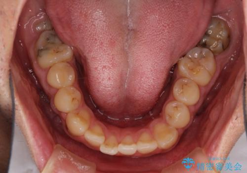 前歯のデコボコとクロスバイトをインビザライン矯正で改善の治療前