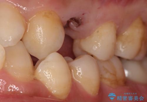 【インプラント】歯が無いので入れて欲しい!の治療前