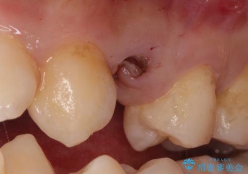 【インプラント】歯が無いので入れて欲しい!の治療前