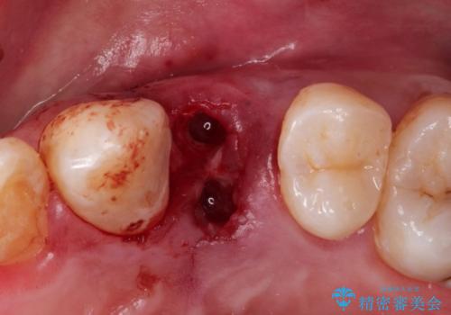 【インプラント】歯が無いので入れて欲しい!の治療中