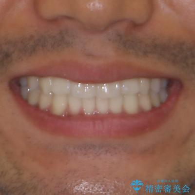 前歯のデコボコを治したい　インビザライン矯正治療の治療後（顔貌）