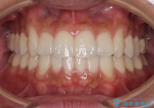 前歯のデコボコを治したい インビザライン矯正治療の症例 治療後