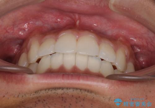 前歯のデコボコを治したい インビザライン矯正治療の治療後