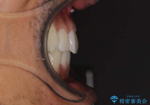 前歯のデコボコを治したい インビザライン矯正治療の治療後