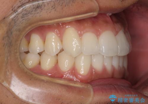 前歯のデコボコを治したい インビザライン矯正治療の治療後