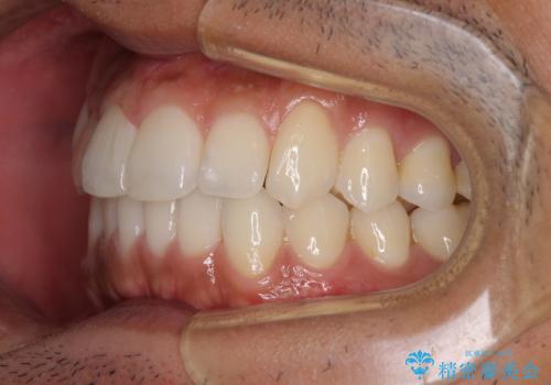 前歯のデコボコを治したい インビザライン矯正治療の治療後
