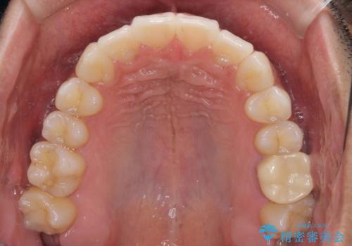 前歯のデコボコを治したい インビザライン矯正治療の治療後
