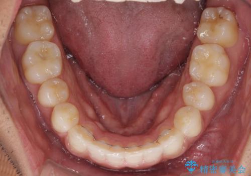 前歯のデコボコを治したい インビザライン矯正治療の治療後