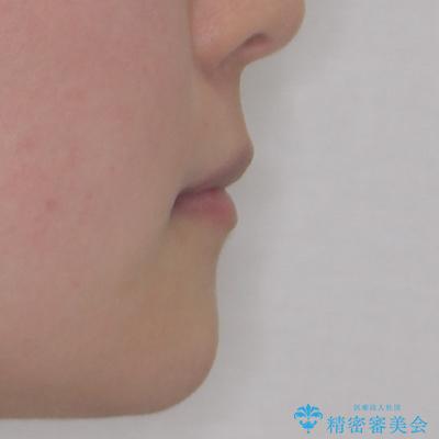口元の突出感を抜歯矯正で改善 メタル装置で費用を抑えるの治療後(顔貌)