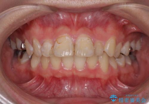 前に飛び出した前歯を治したい ワイヤー装置による抜歯矯正治療の治療前