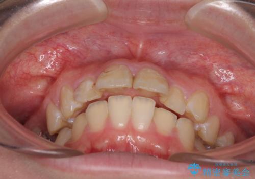 前に飛び出した前歯を治したい ワイヤー装置による抜歯矯正治療の治療前