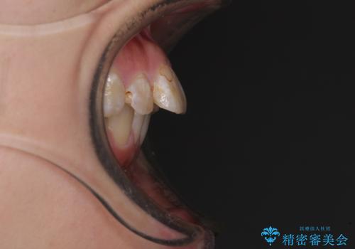 前に飛び出した前歯を治したい ワイヤー装置による抜歯矯正治療の治療前