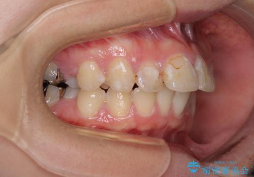 前に飛び出した前歯を治したい ワイヤー装置による抜歯矯正治療の治療前