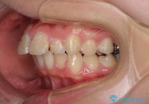 前に飛び出した前歯を治したい　ワイヤー装置による抜歯矯正治療の治療前