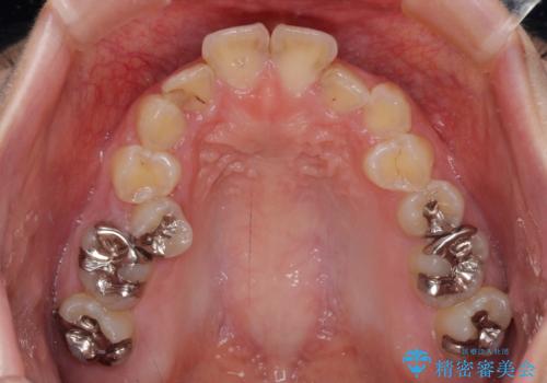 前に飛び出した前歯を治したい ワイヤー装置による抜歯矯正治療の治療前