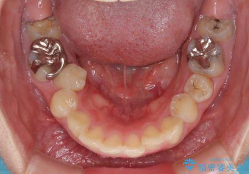 前に飛び出した前歯を治したい ワイヤー装置による抜歯矯正治療の治療前