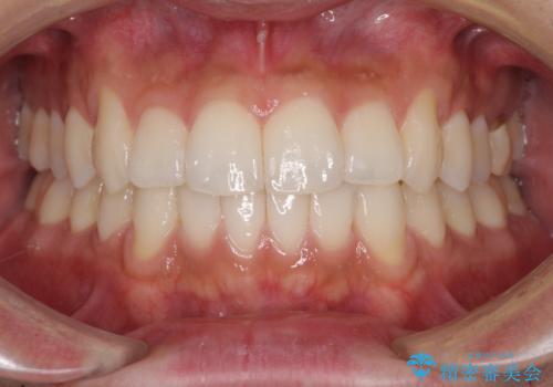 前歯のデコボコを治したい インビザライン矯正治療の治療中