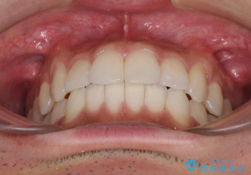 前歯のデコボコを治したい インビザライン矯正治療の治療中