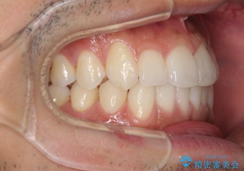 前歯のデコボコを治したい インビザライン矯正治療の治療中