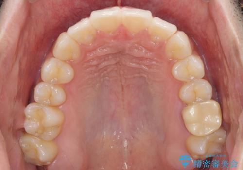 前歯のデコボコを治したい インビザライン矯正治療の治療中