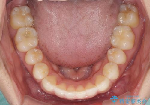 前歯のデコボコを治したい インビザライン矯正治療の治療中