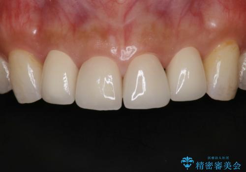 前歯の形気になる セラミッククラウン(SP)の治療後