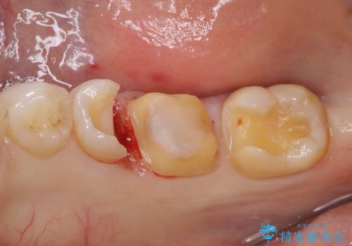 歯と歯の間によくものが詰まる。。セラミック治療の治療中