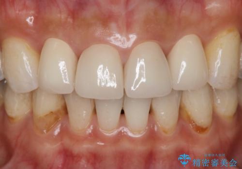 前歯の形気になる　セラミッククラウン(SP)の症例 治療後