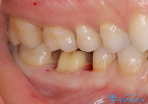 歯と歯の間によくものが詰まる。。セラミック治療の治療中