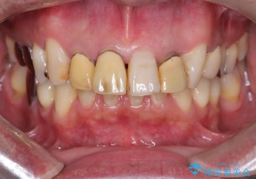 【オールセラミッククラウン】被せ物の色が気になる!の治療前