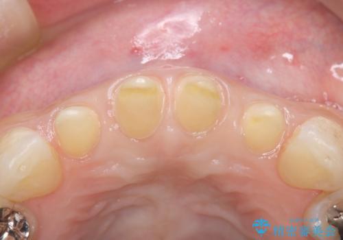 前歯の形気になる セラミッククラウン(SP)の治療中
